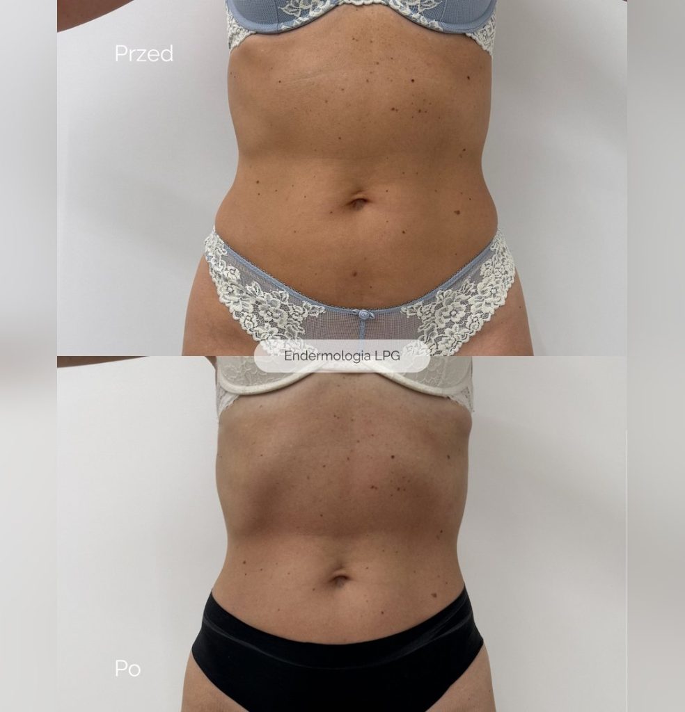 Endermologia LPG Infinity - efekty zabiegu przed i po