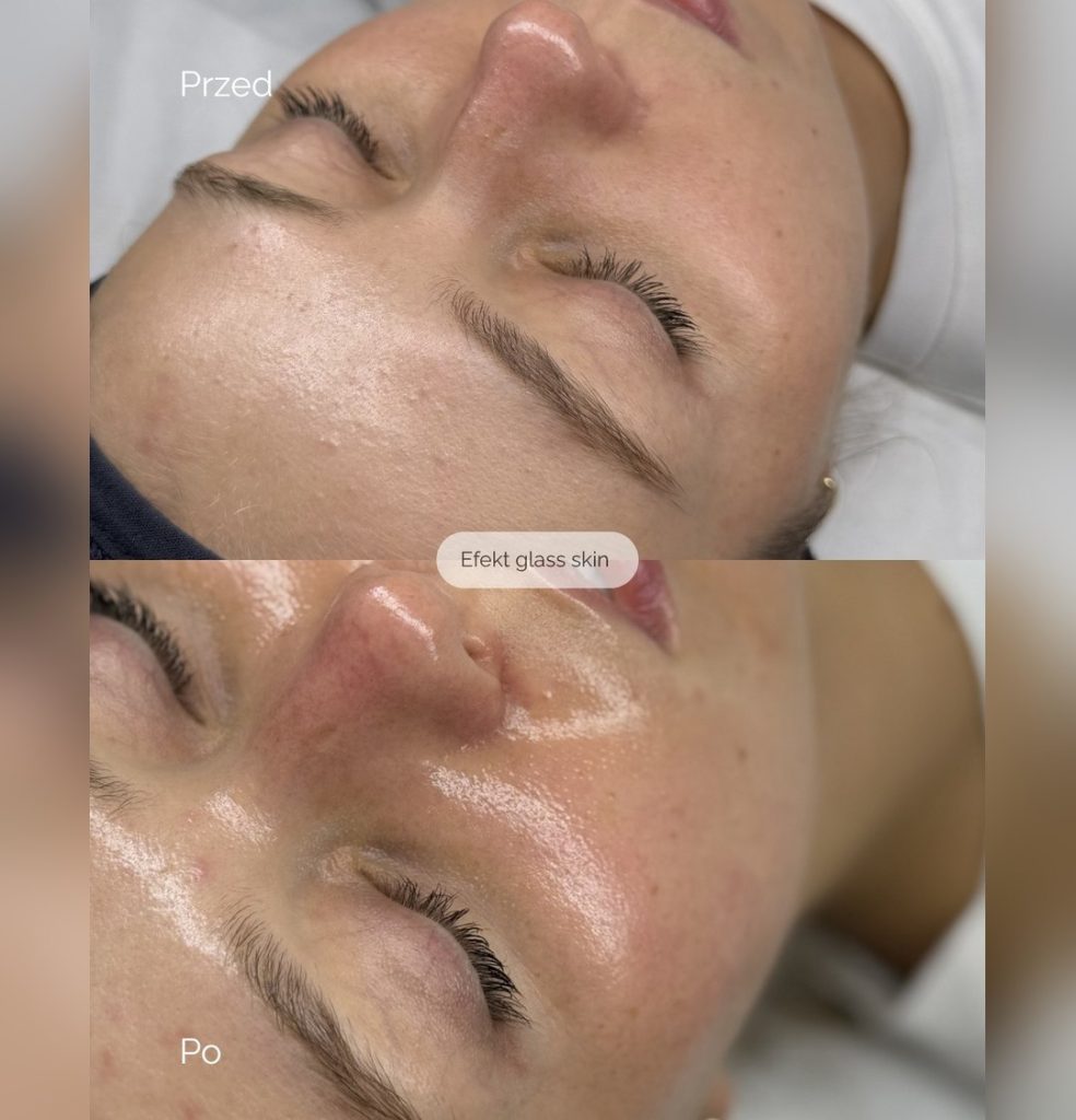 Peelingi PCA Skin - efekty zabiegu przed i po